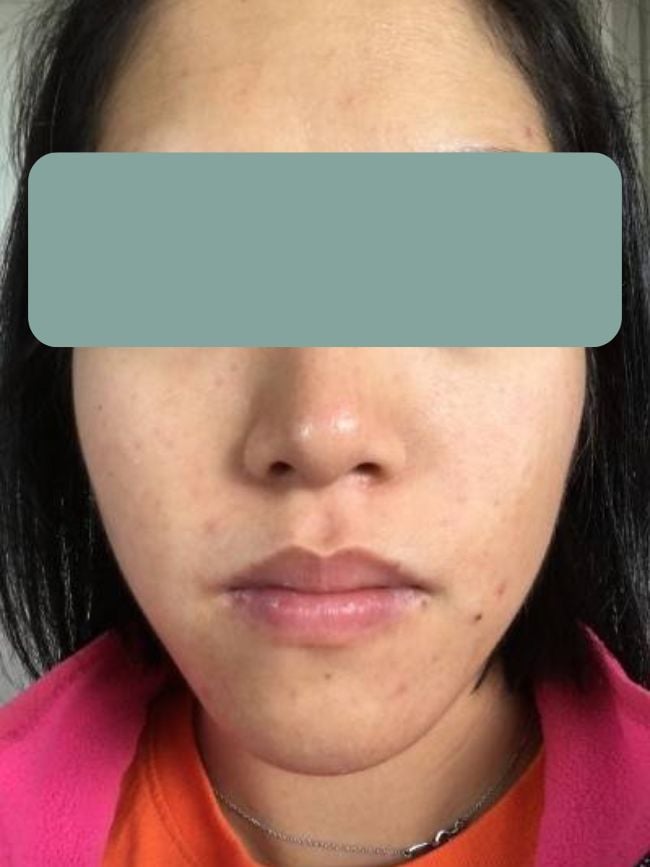 acne-functional-medicine-after-two young woman clear skin on face following acne treatment