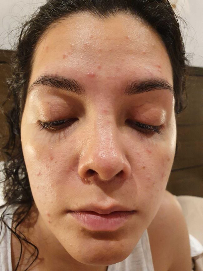 acne-functional-medicine-before-one young woman with acne all over face eyes closed