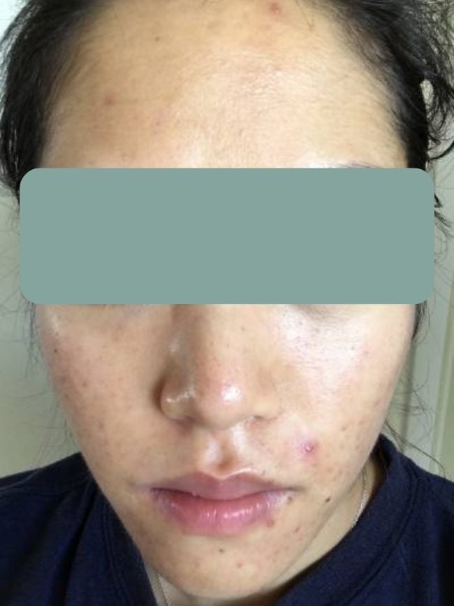 acne-functional-medicine-before-two young woman acne on face especially around mouth cheeks