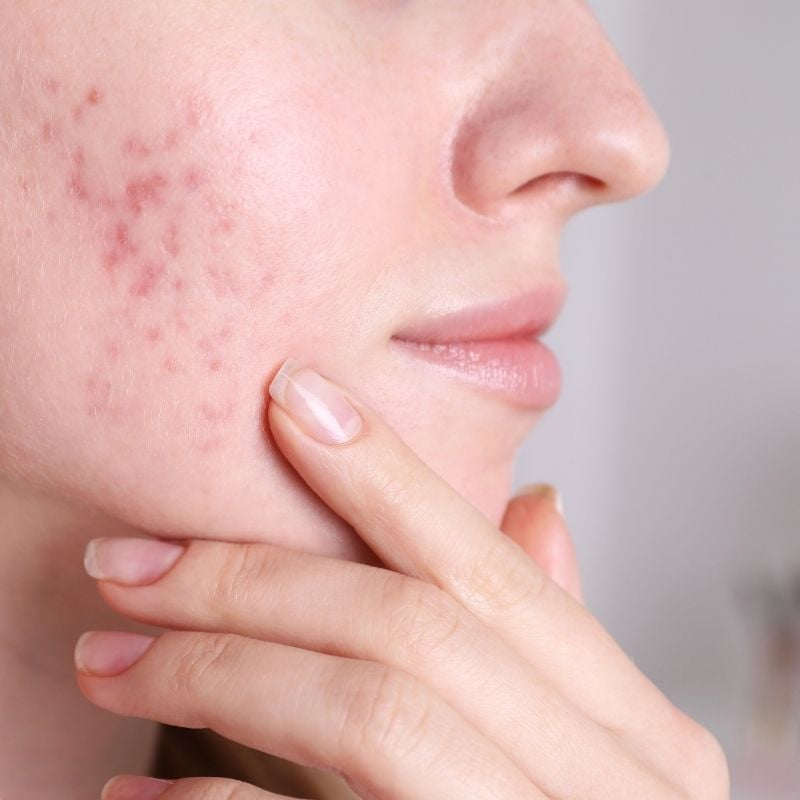 acne-functional-medicine-condition side profile woman's face acne on cheeks