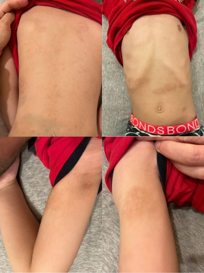 eczema-functional-medicine-arm-after-one clear skin on torso and arms following eczema treatment