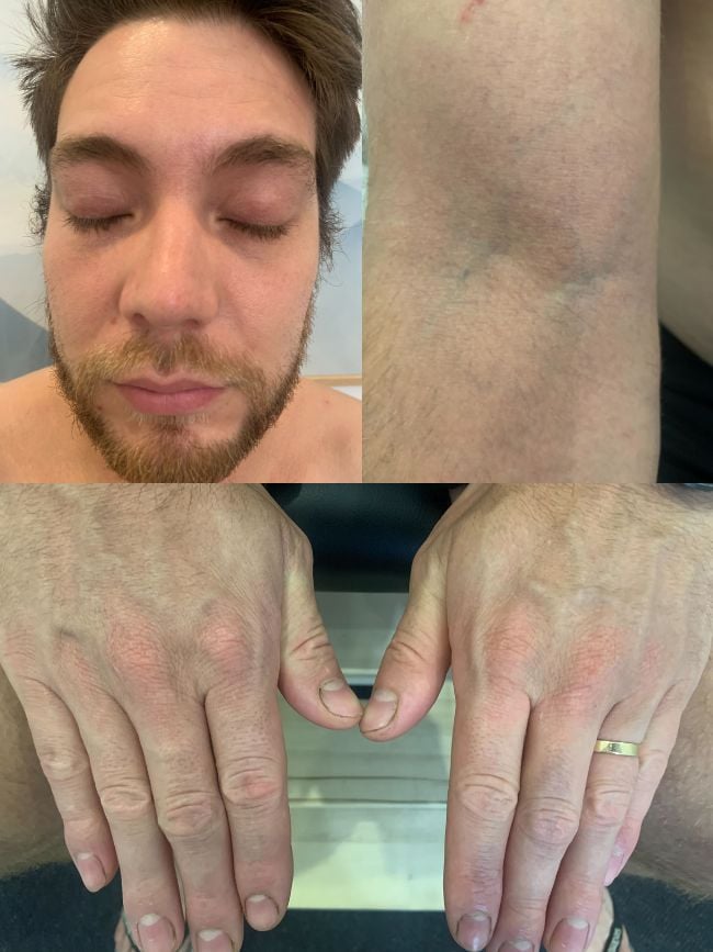 eczema-functional-medicine-arm-after-two clear skin on man's face arms hands following eczema treatment
