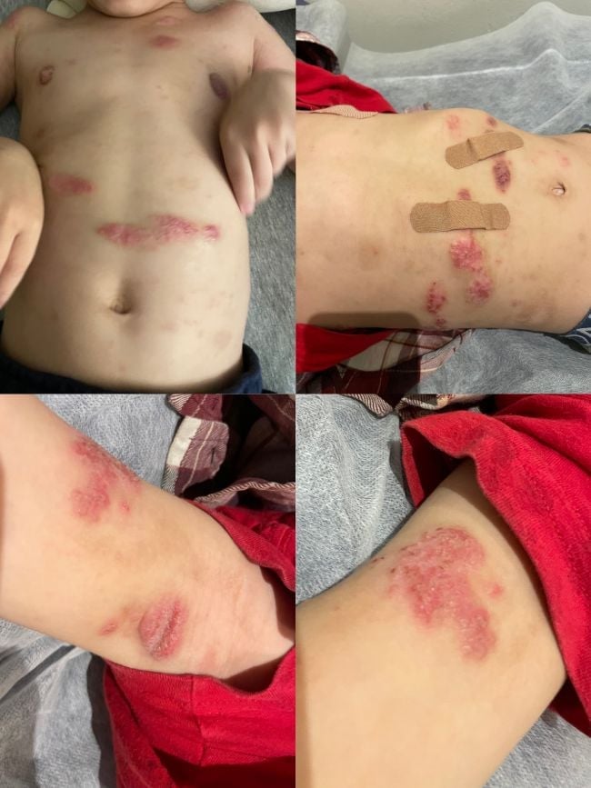 eczema-functional-medicine-arm-before-one patches of red inflamed eczema on torso arms