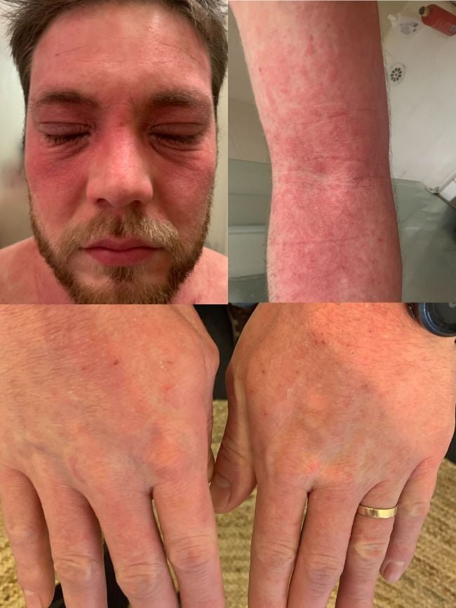 eczema-functional-medicine-arm-before-two man's face arms hands very red and swollen with eczema