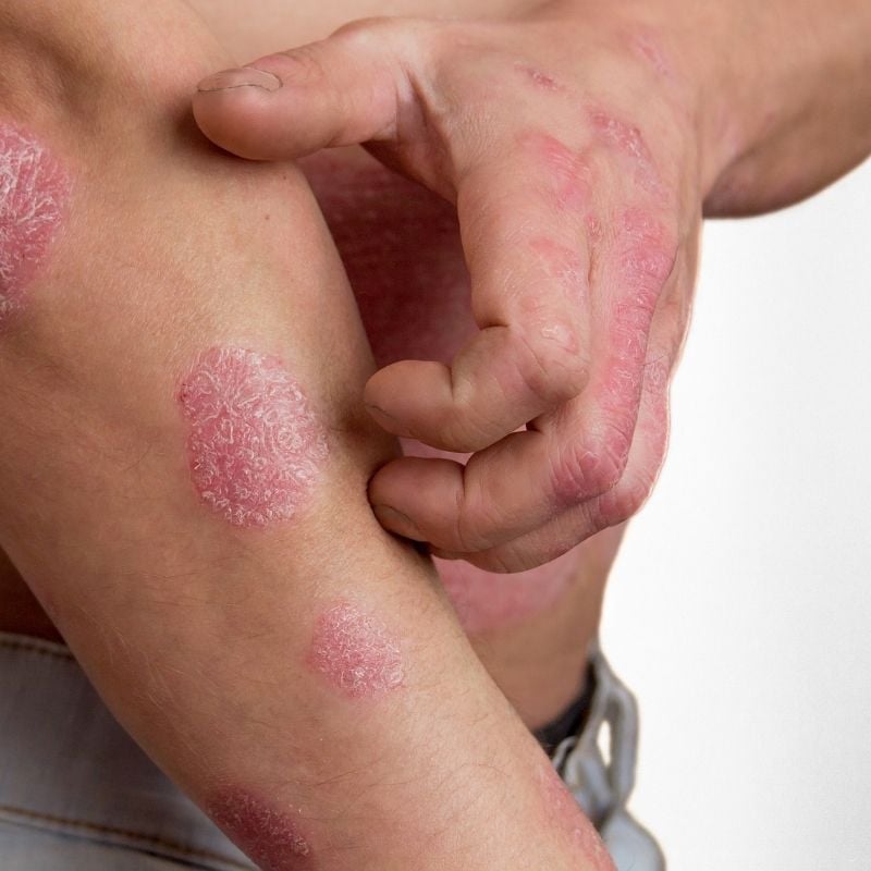 eczema-functional-medicine-condition male with red itchy eczema on hands arms scratching at arm