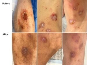 six images comparing broken skin eczema wounds before with healed skin following treatment