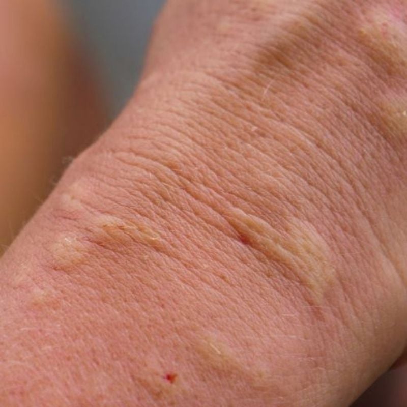 close up of raised welts hives red skin on wrist of adult