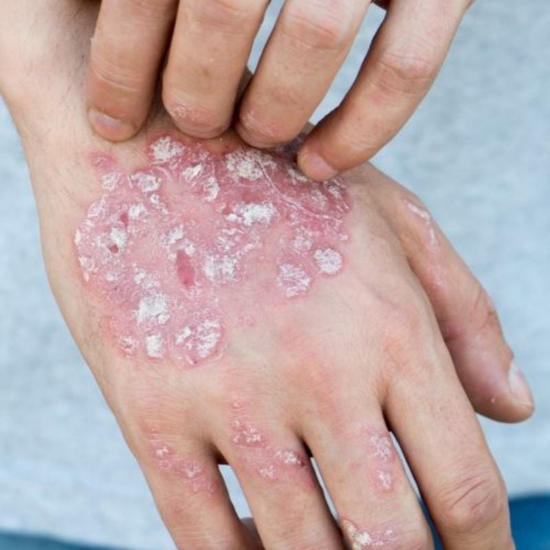 psoriasis-functional-medicine-condition close up of man itching back of one of his hands covered in severe psoriasis dry red skin