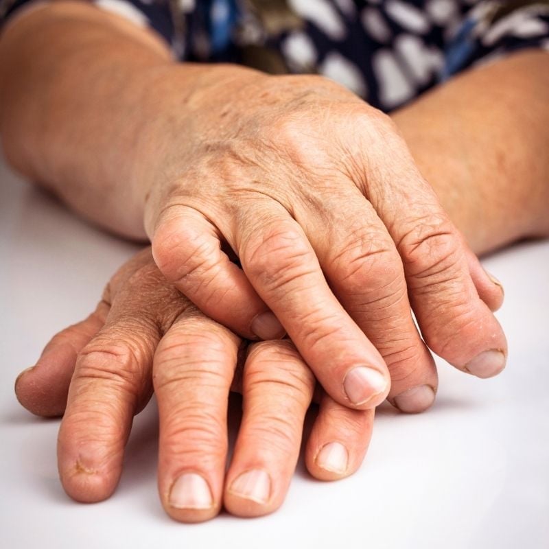 rheumatoid-arthritis-functional-medicine-condition swollen hands of older person with rheumatoid arthritis