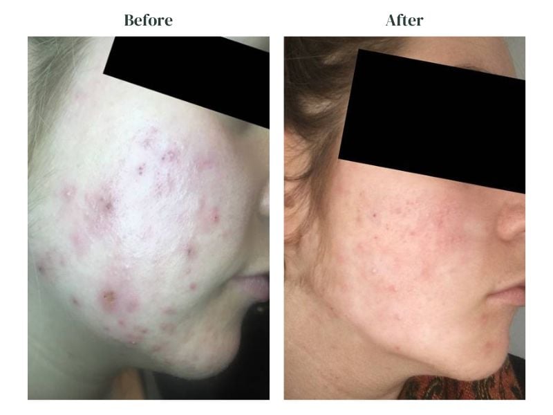 side profile of woman's face with acne next to side profile of woman's face with no acne