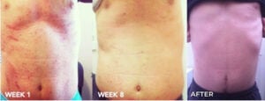 three images comparing the progressive improvement of eczema symptoms on male torso